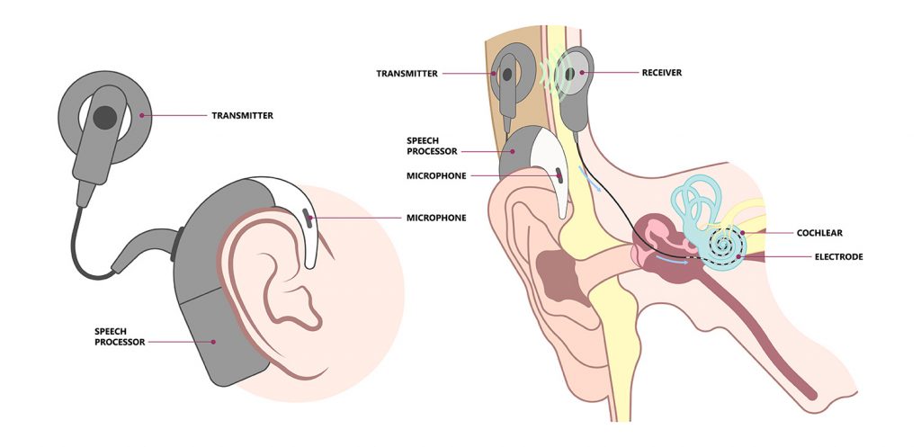 Can conductive hearing loss be treated