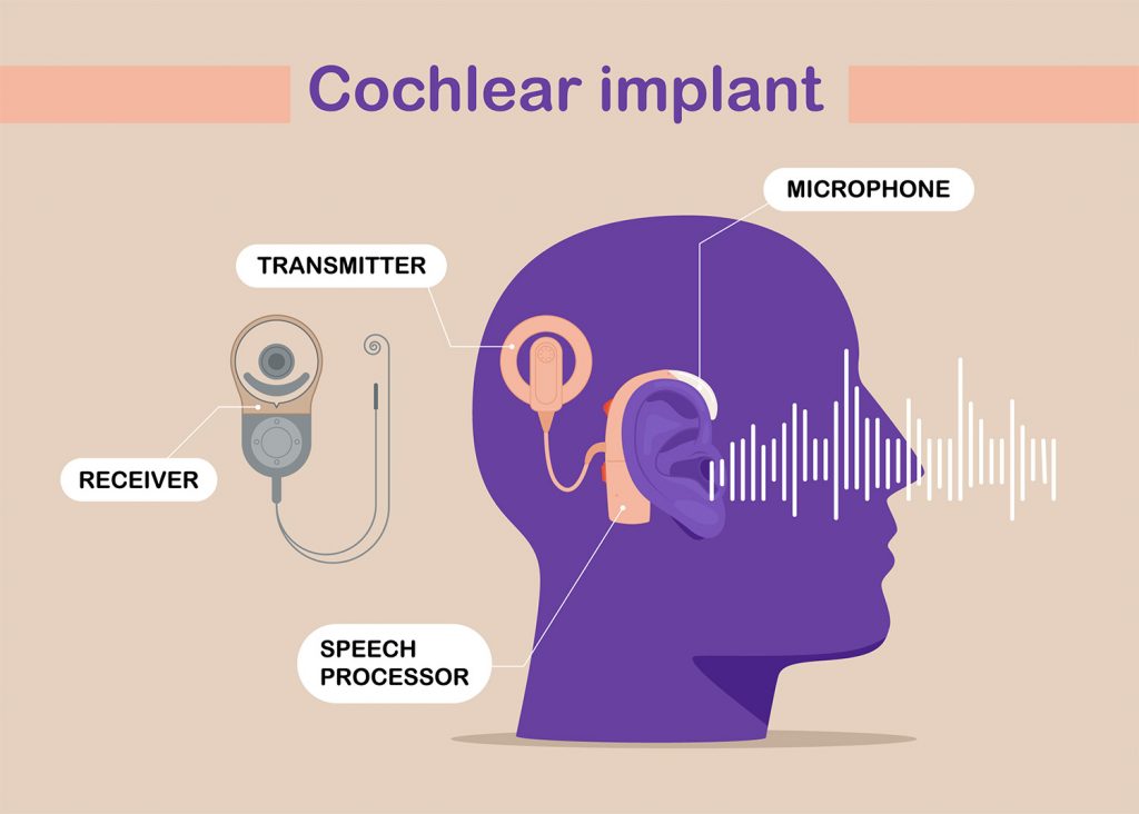 How Can Cochlear Implants Help With Sensorineural Hearing Loss?