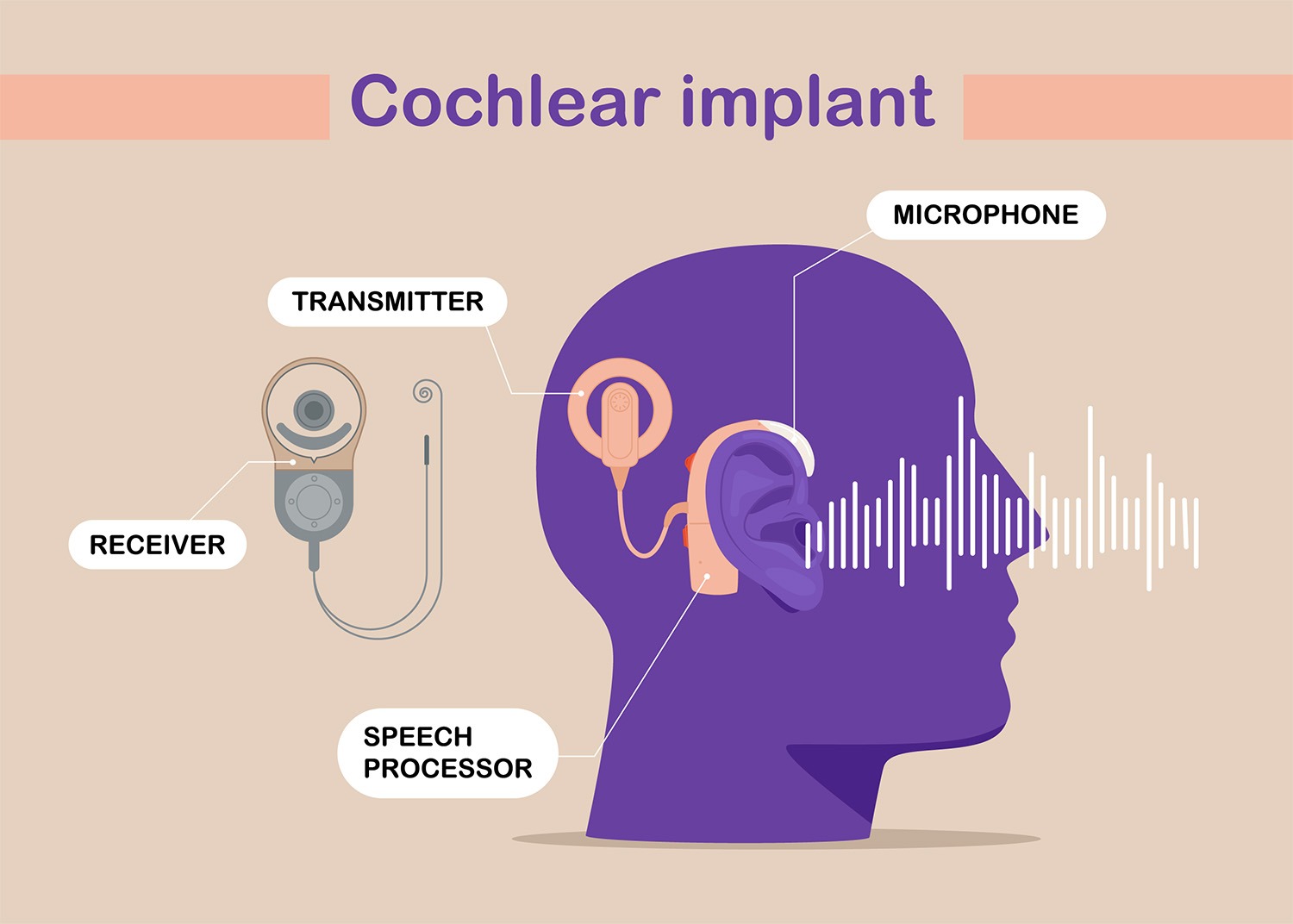 Cochlear Implants Auditorey